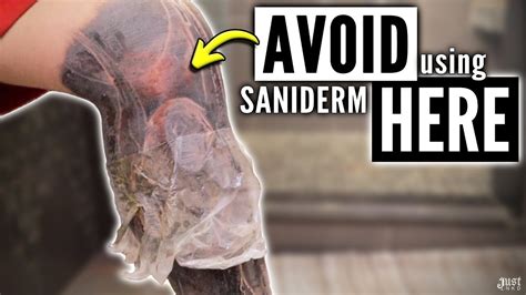 saniderm spray|What to Do if Saniderm Is Stuck to Your Tattoo